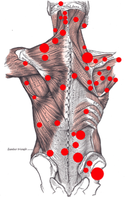 triggerpoints